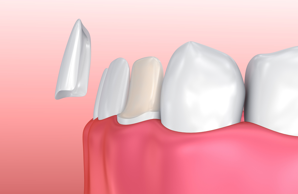 dental-veneer-cosmetic-and-family-dentistry-of-las-colinas
