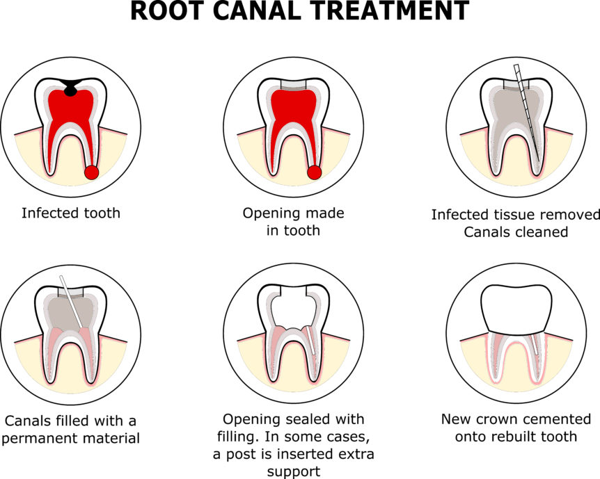 what-is-a-root-canal-cosmetic-family-dentistry-of-las-colinas