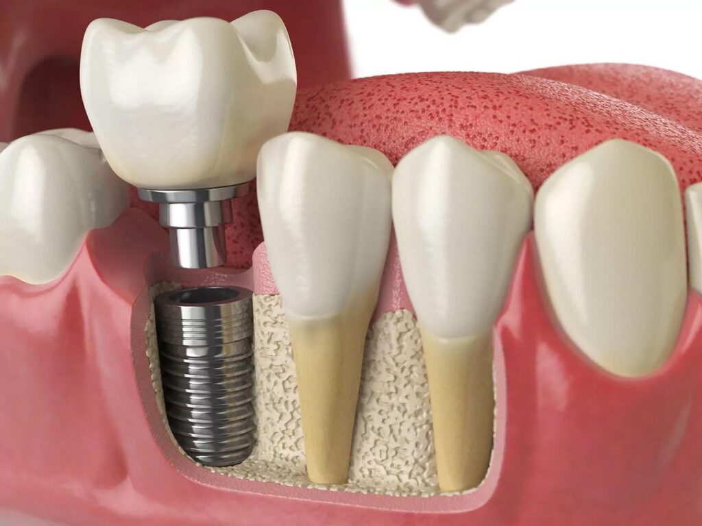 dental implants image