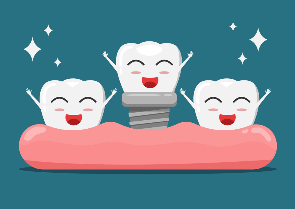 Dental Implants