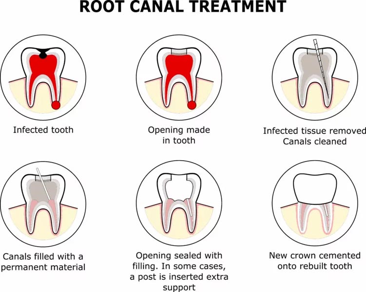 Image explaining Root Canal Treatment