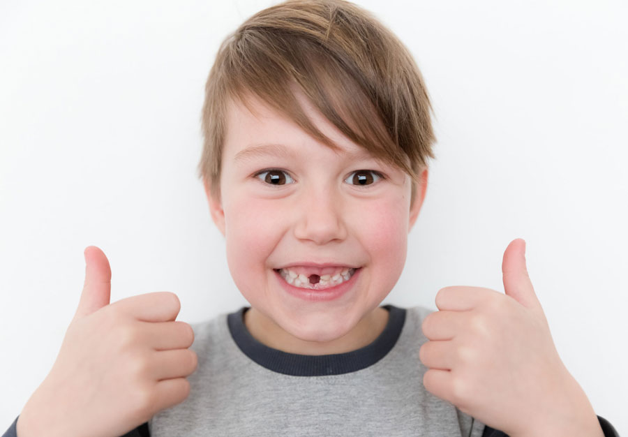 a child showing his broken teeth