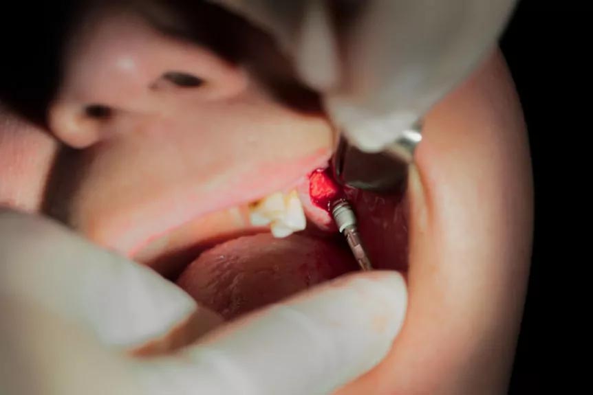 bone grafting Surgery
