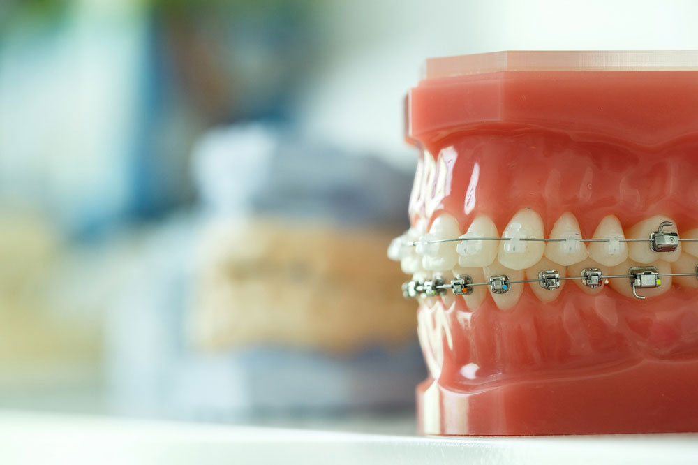 fake teeth with braces